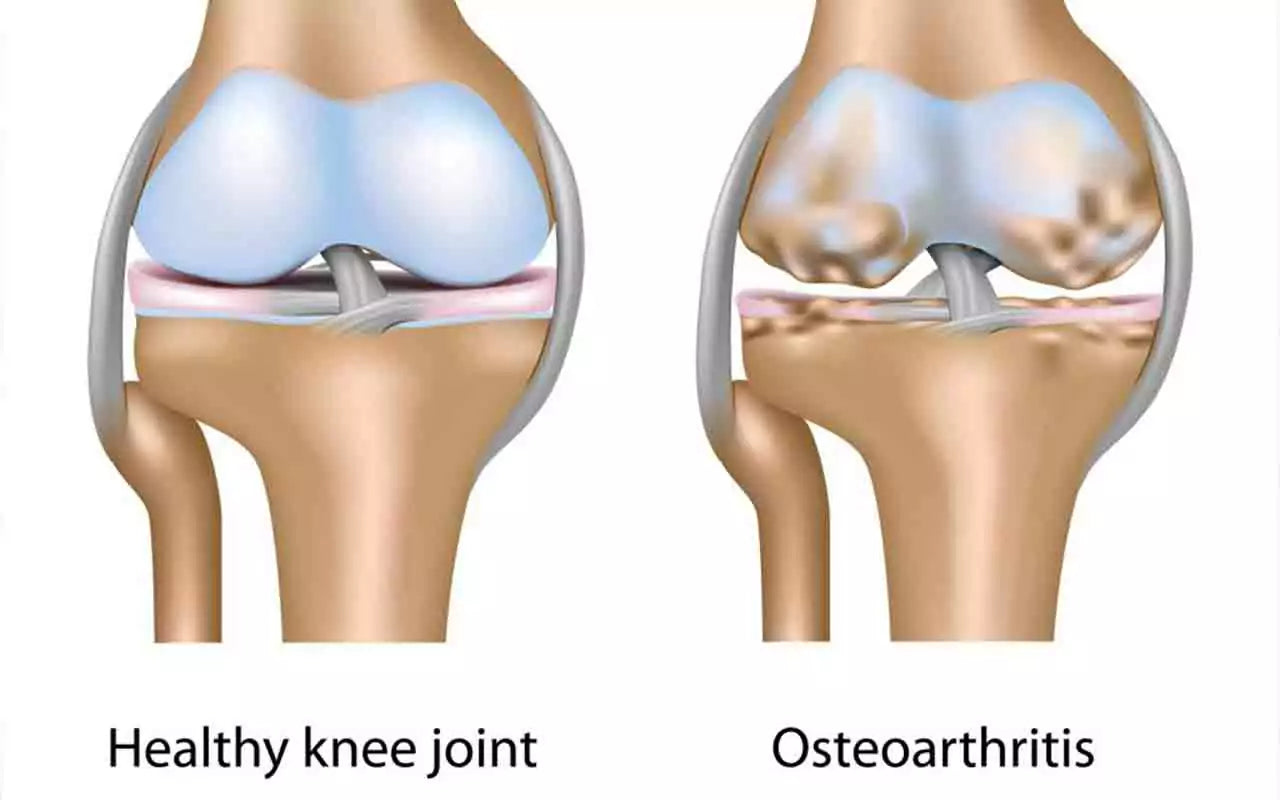Is Osteoarthritis Causing You Knee Joint Pain?