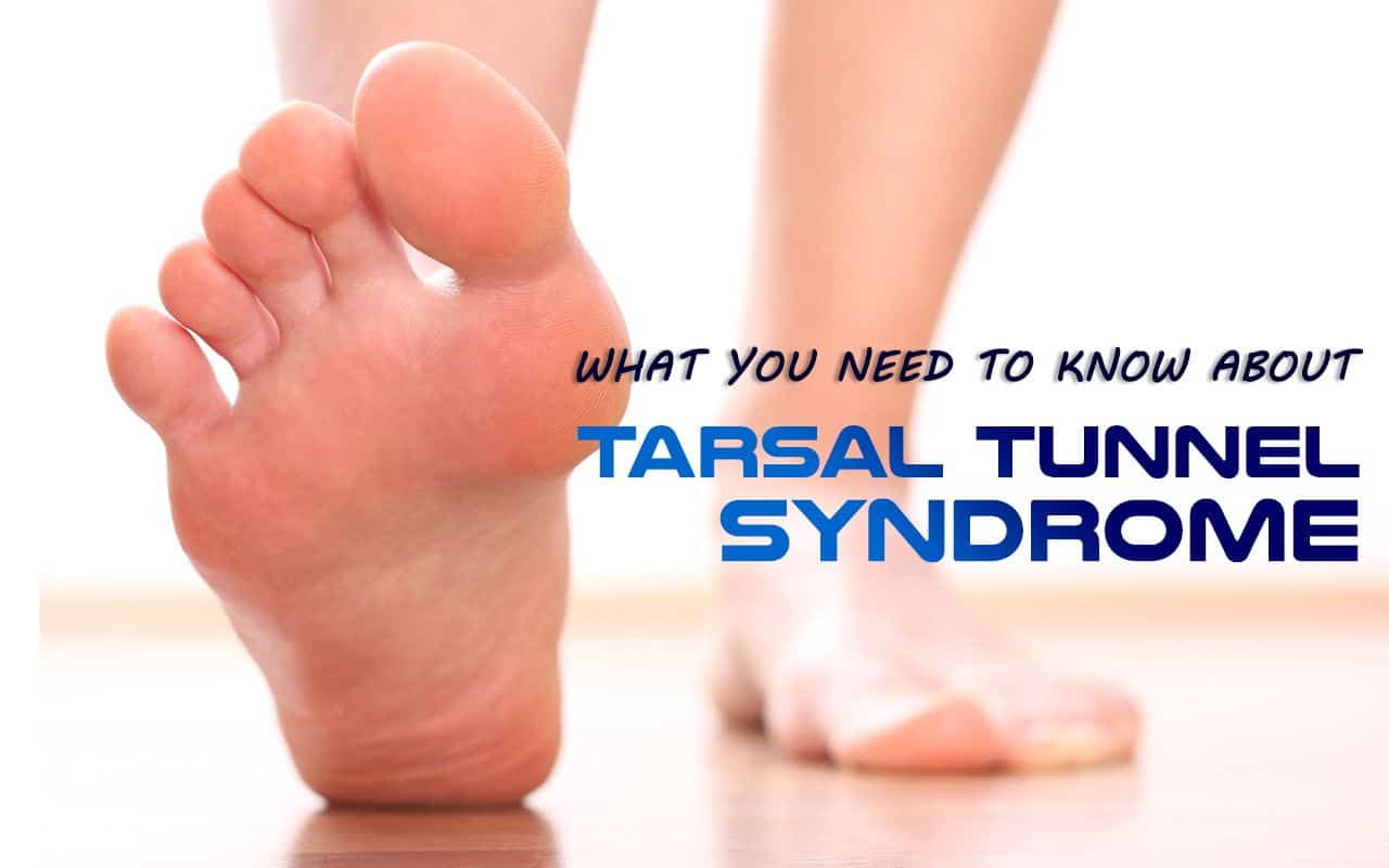 Tarsal Tunnel Syndrome Guide - What You Need to Know