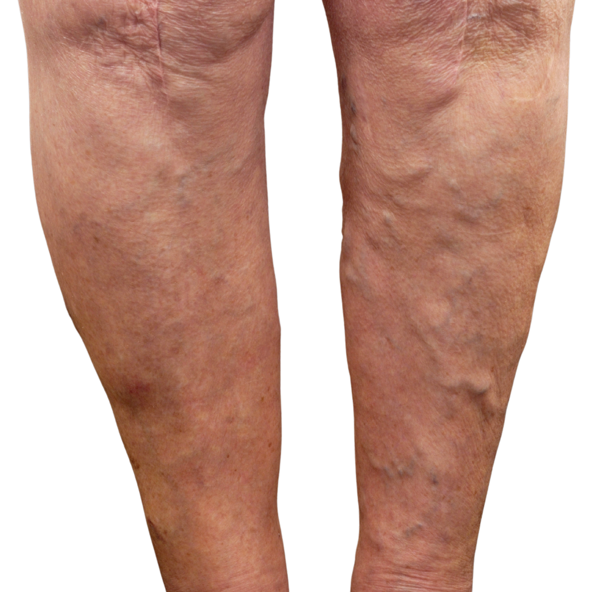 Compression Socks and Varicose Veins: How They Help Ease the Ache
