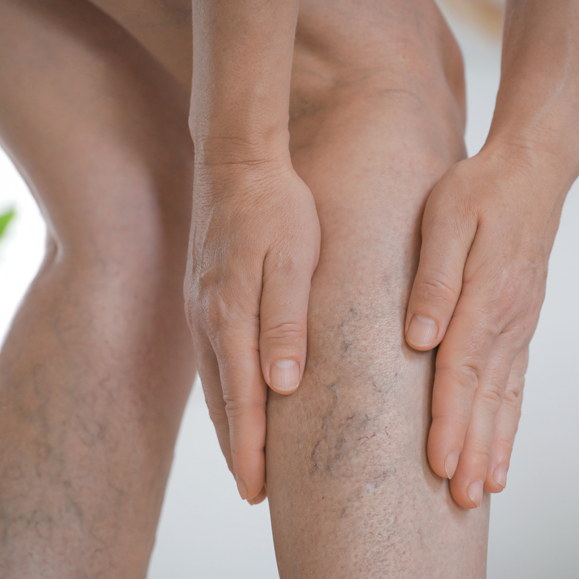 Leg Swelling & Circulation Issues